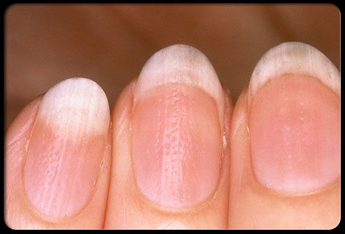 artropatie psoriazica articulația degetului arătător doare dimineața
